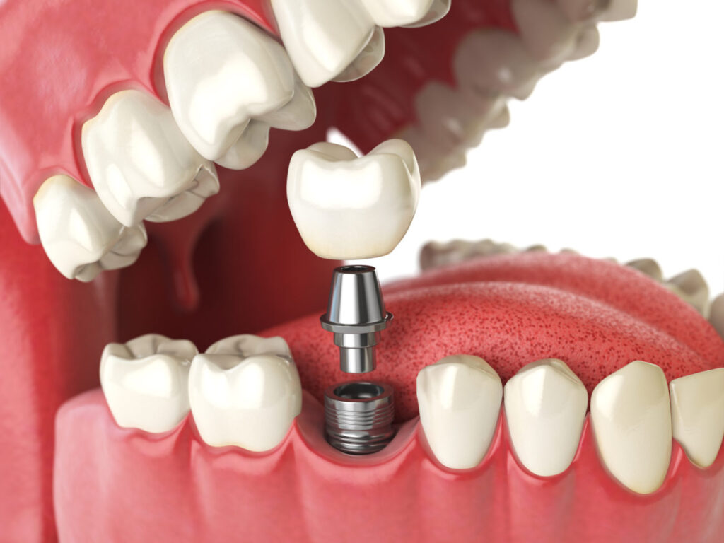Full mouth dental implant vs. Single tooth Dental Implant