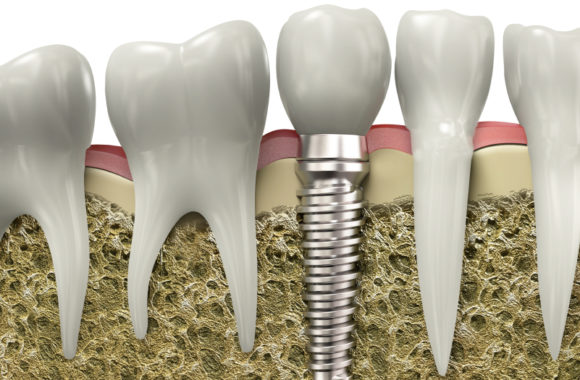 $399 Dental Implants